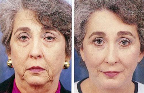 Stručnjaci su šokirani! Beauty Derm uklanja bore – čak i na vratu – već za samo 4 dana!